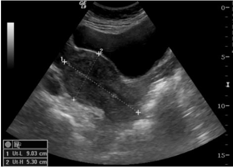 Pelvic Ultrasound Quick for Patients